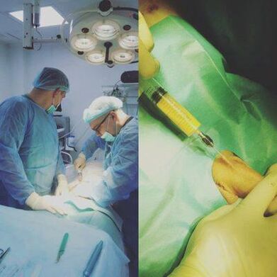 Eine Verdickung des Penis ist mit Hilfe einer Operation möglich