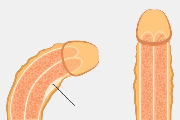 effektiver Weg, um den Penis zu begradigen